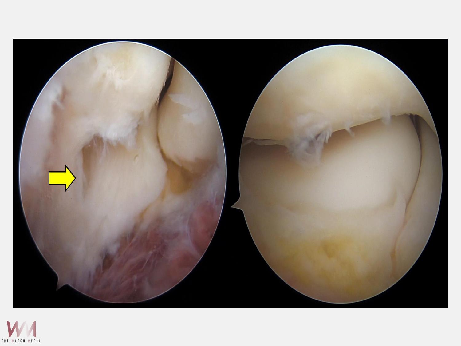 手肘外側疼痛不只是「網球肘」　微創關節鏡手術助女會計師恢復生活日常 - https://www.watchmedia01.com