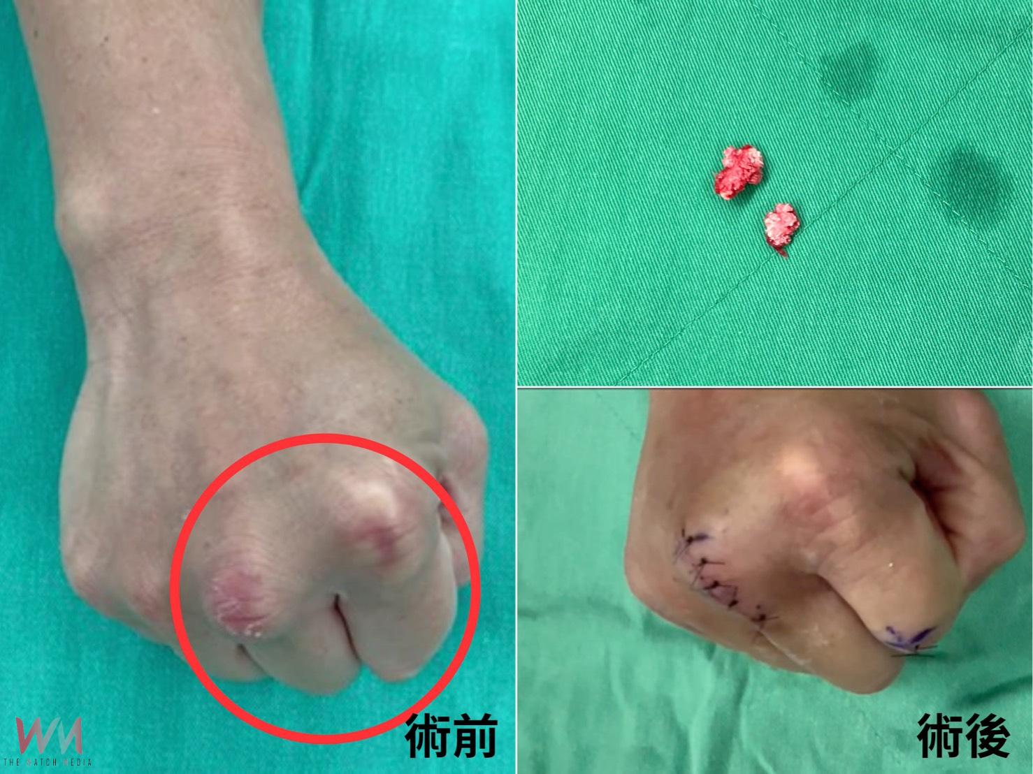 竹科工程師敲鍵盤卡卡　微創超音波刀清除惱人痛風石解困 - https://www.watchmedia01.com